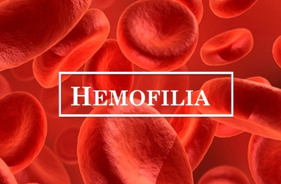 Hemofilia – co wiemy o tej chorobie? LIFESTYLE, Zdrowie - Odpowiedzi na pytanie o hemofilię, postawione podczas sondy ulicznej mogą zaskakiwać. Polacy nie mają dużej wiedzy na jej temat, chociaż jest to jedna z najczęstszych skaz krwotocznych i najwcześniej rozpoznawanych chorób genetycznych.